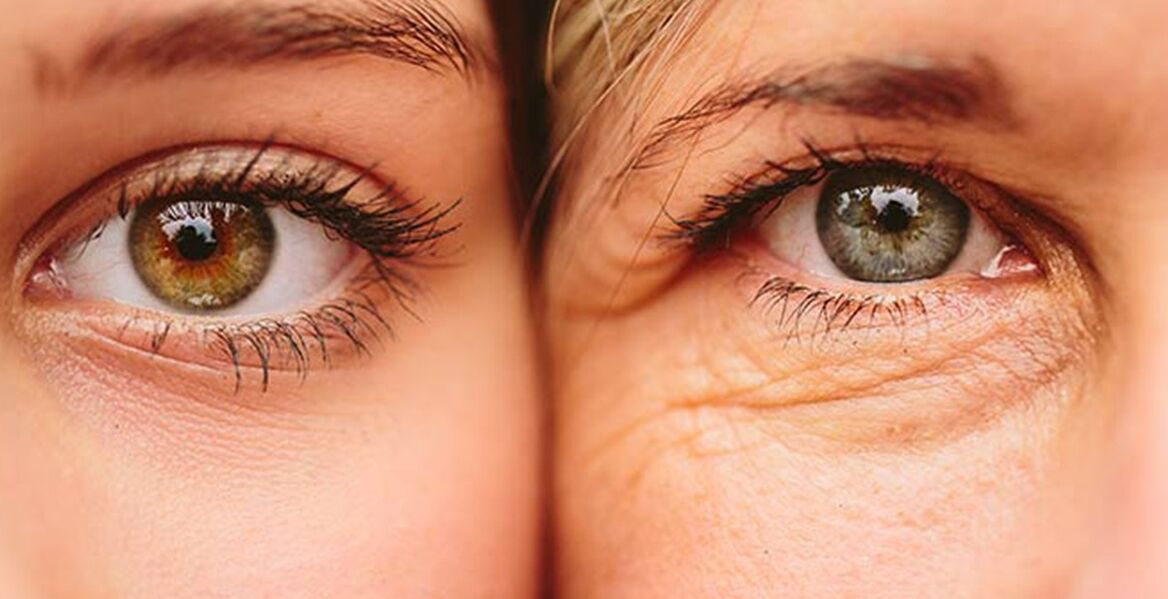 External signs of skin aging around the eyes in two women of different ages
