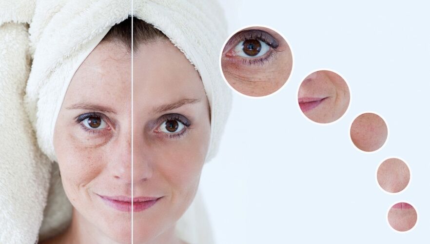 before and after plasma skin rejuvenation