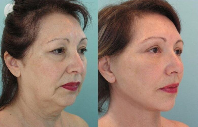 Results of facelift rejuvenation with thread
