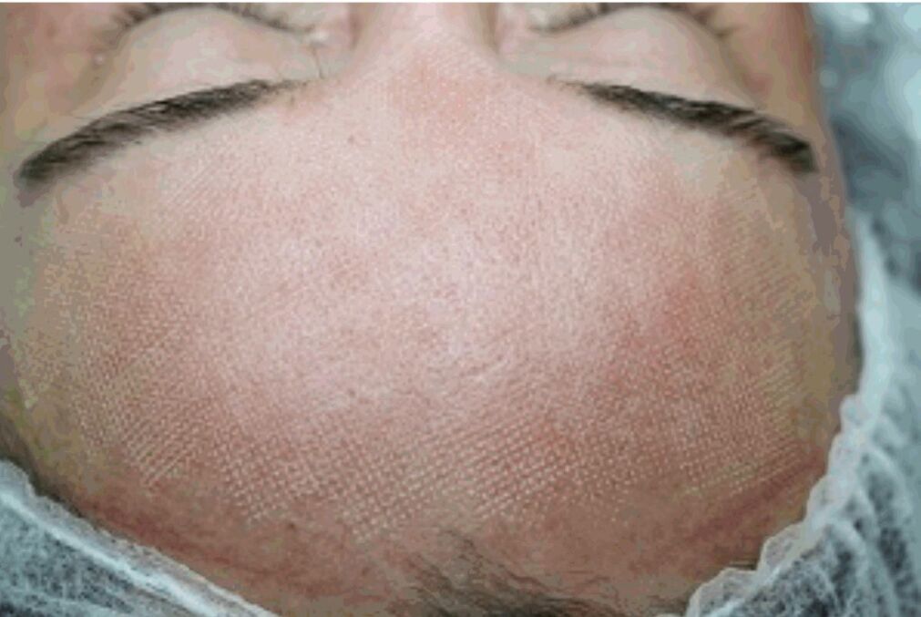 Mild redness and swelling after fractional lasers