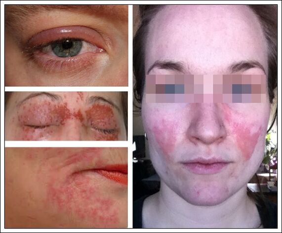 allergic to anti-aging masks