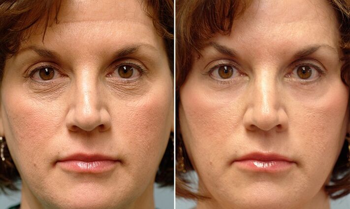 face before and after fractional rejuvenation by laser