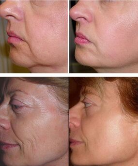 image before and after laser segment rejuvenation